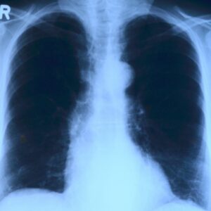 Image of chest x-ray that is required for COPD patients