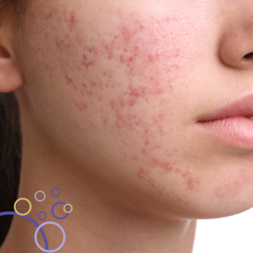 Dermatology - Acne - Red Flags and Differential Diagnosis